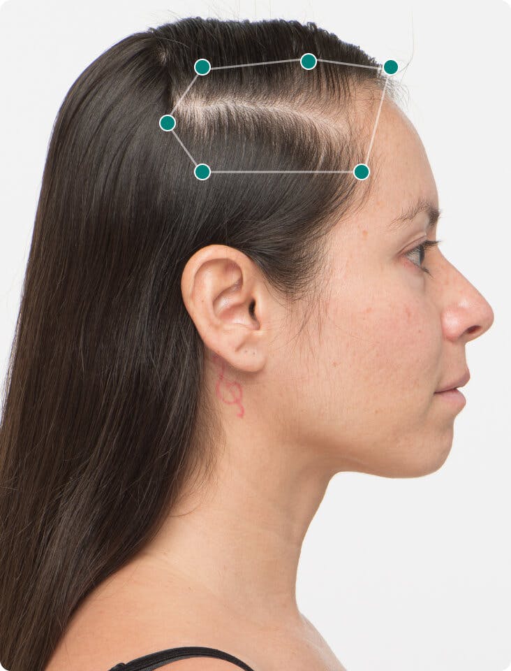 Alejandra before taking Nutrafol Women Hair Growth Nutraceutical.