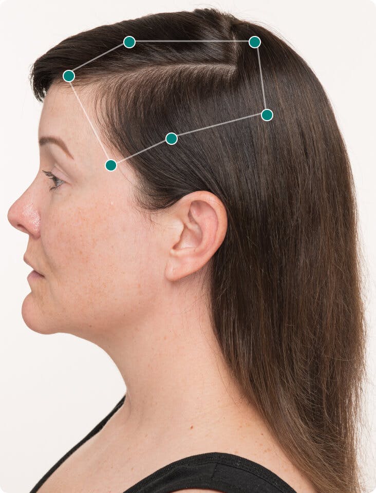 Lindsey 3 months into taking Nutrafol Women Hair Growth Nutraceutical. Results may vary.