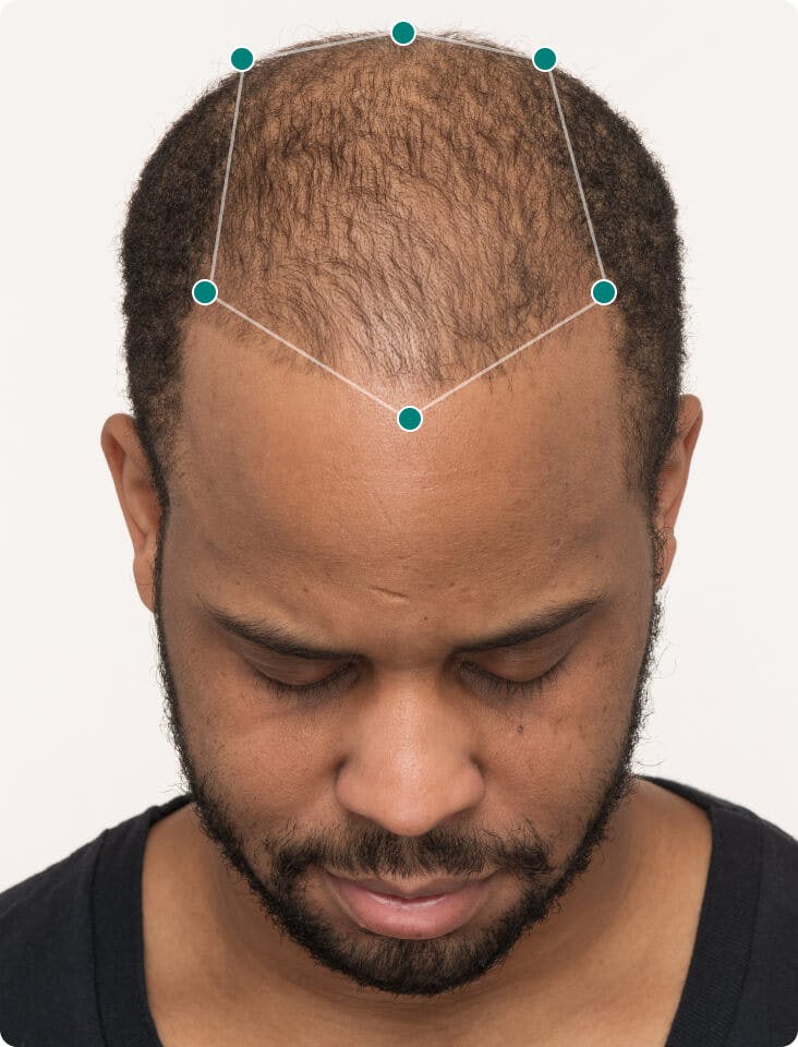 Adrian 3 months into taking Nutrafol Men Hair Growth Nutraceutical. Results may vary.