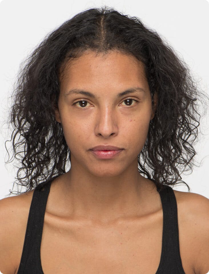 Felisha before taking Women's Vegan Hair Growth Nutraceutical.