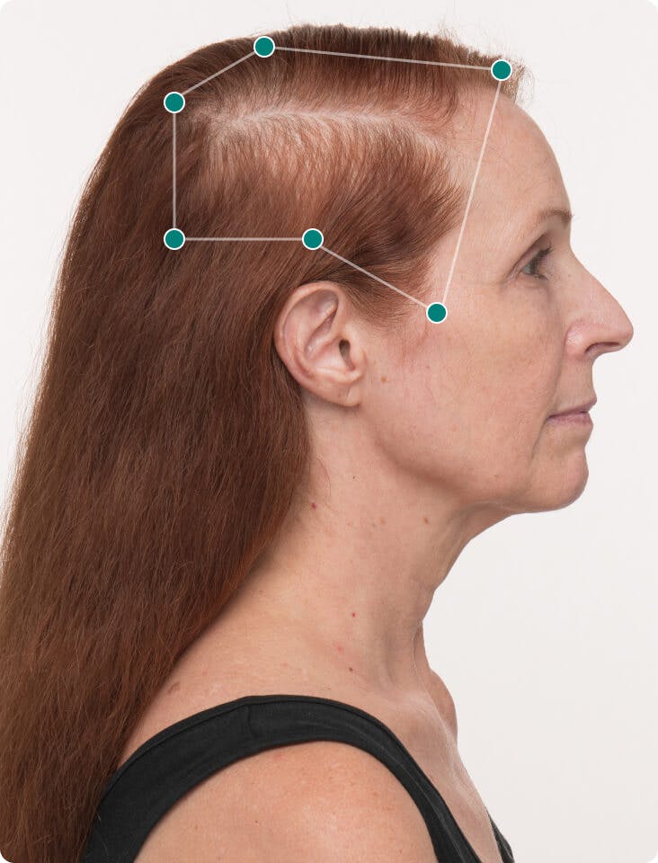 Lydia before taking Women’s Balance Hair Growth Nutraceutical.