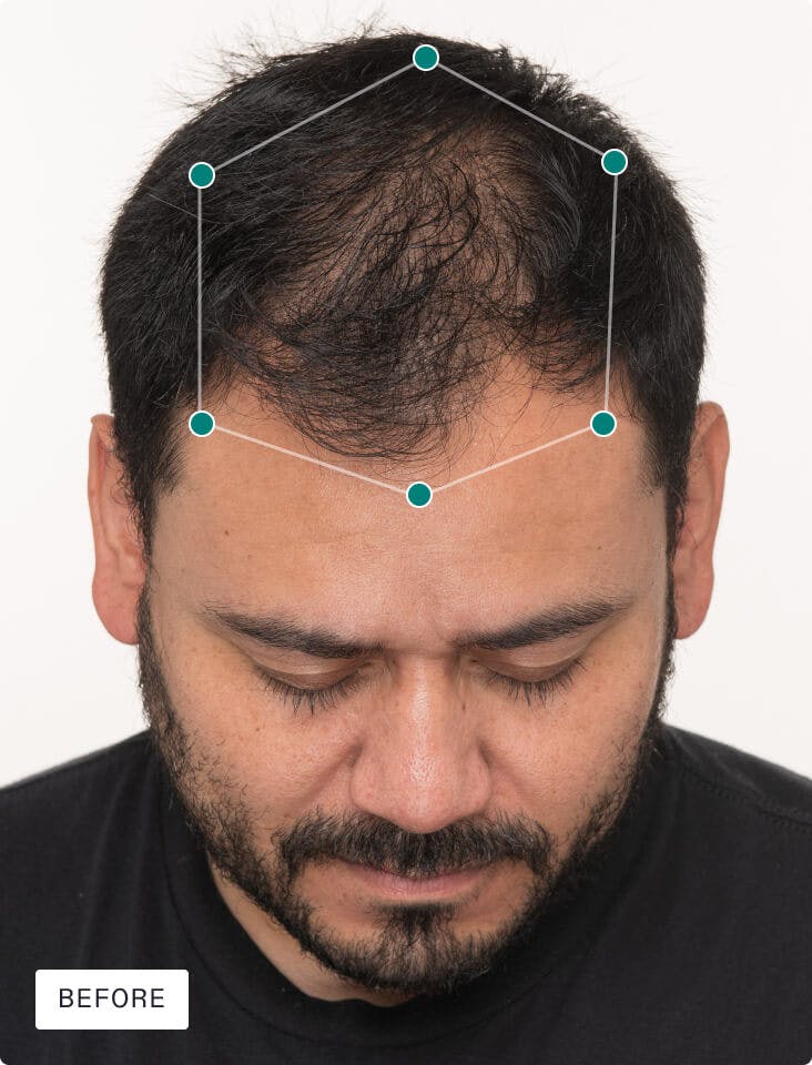 Jose’s scalp before taking Nutrafol.