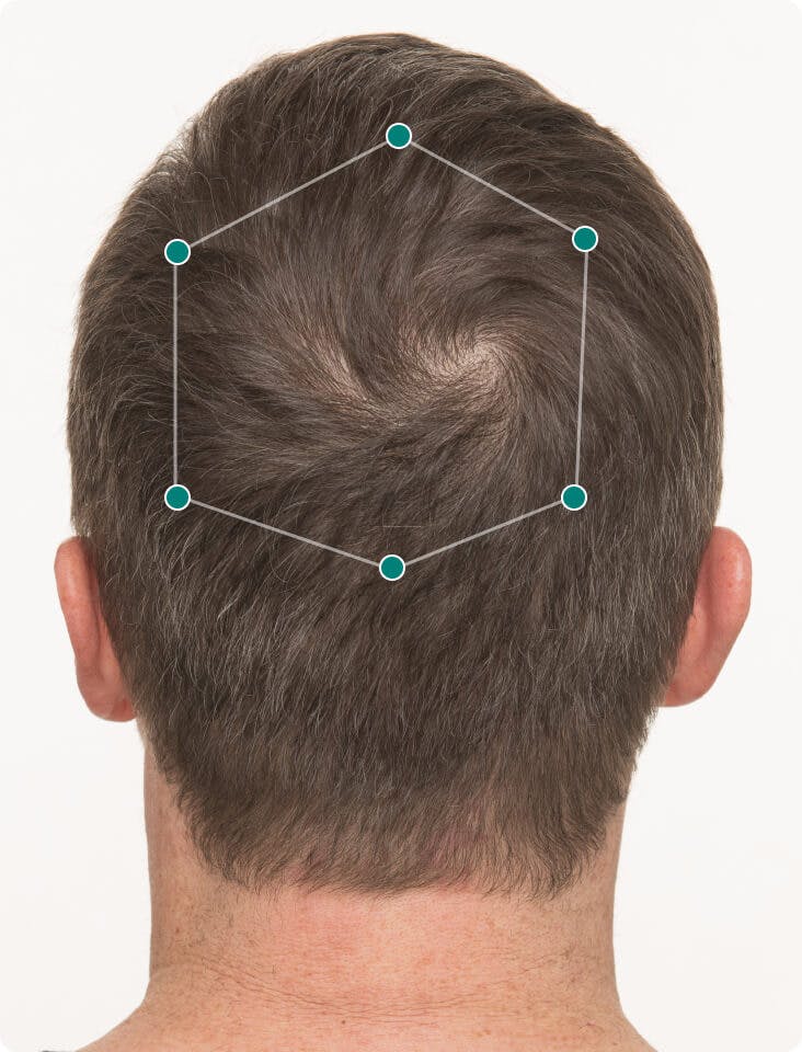 Tanner 3 months into taking Nutrafol Men Hair Growth Nutraceutical. Results may vary.