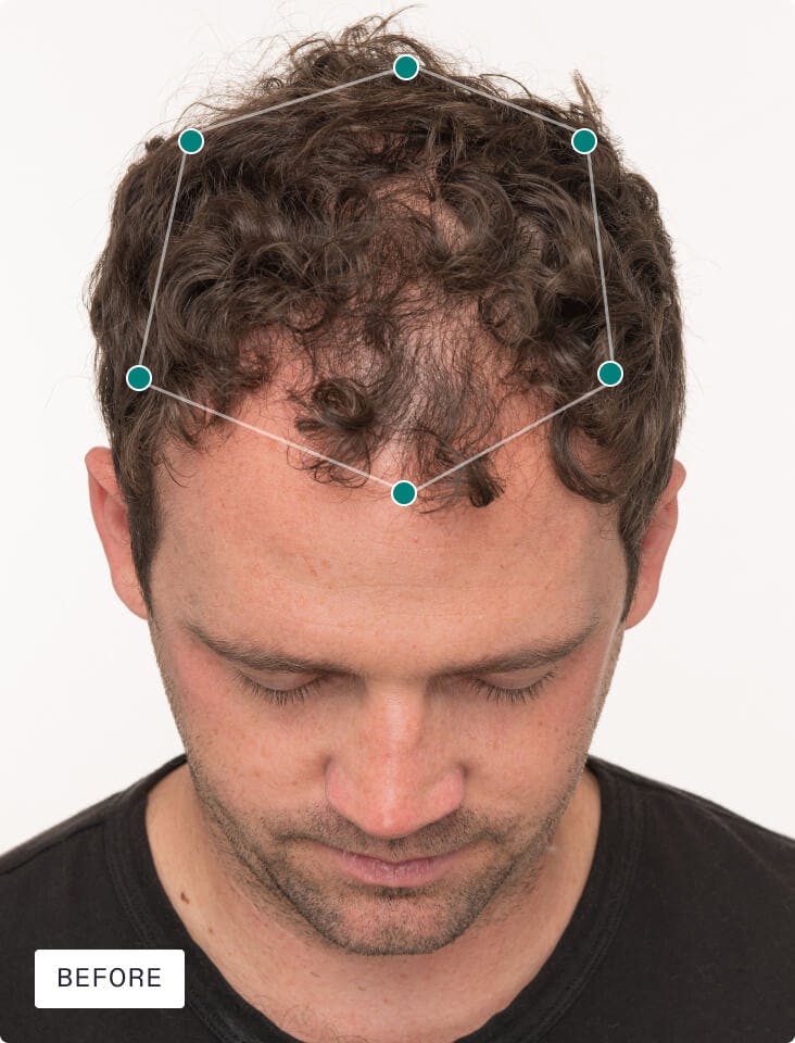 Man’s scalp before taking Men Hair Growth Nutraceutical.