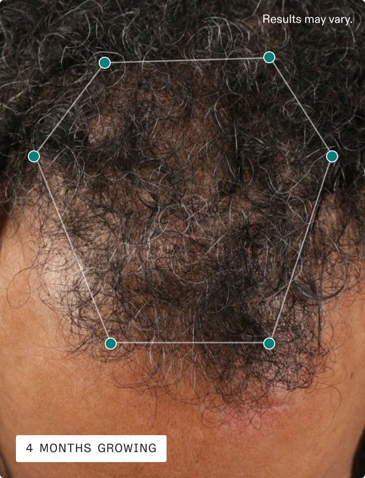 Kyron’s scalp 4 months growing with Nutrafol.