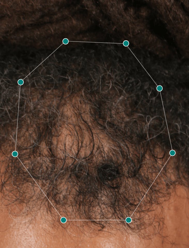 Kyron before taking Nutrafol Men Hair Growth Nutraceutical.