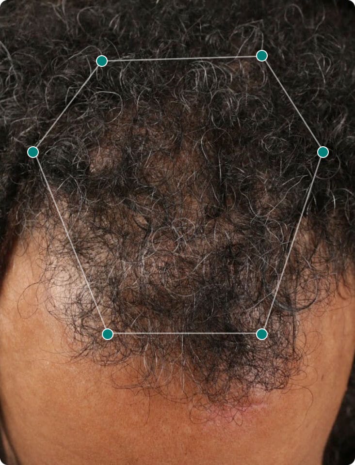 null 4 months into taking Nutrafol Men Hair Growth Nutraceutical. Results may vary.