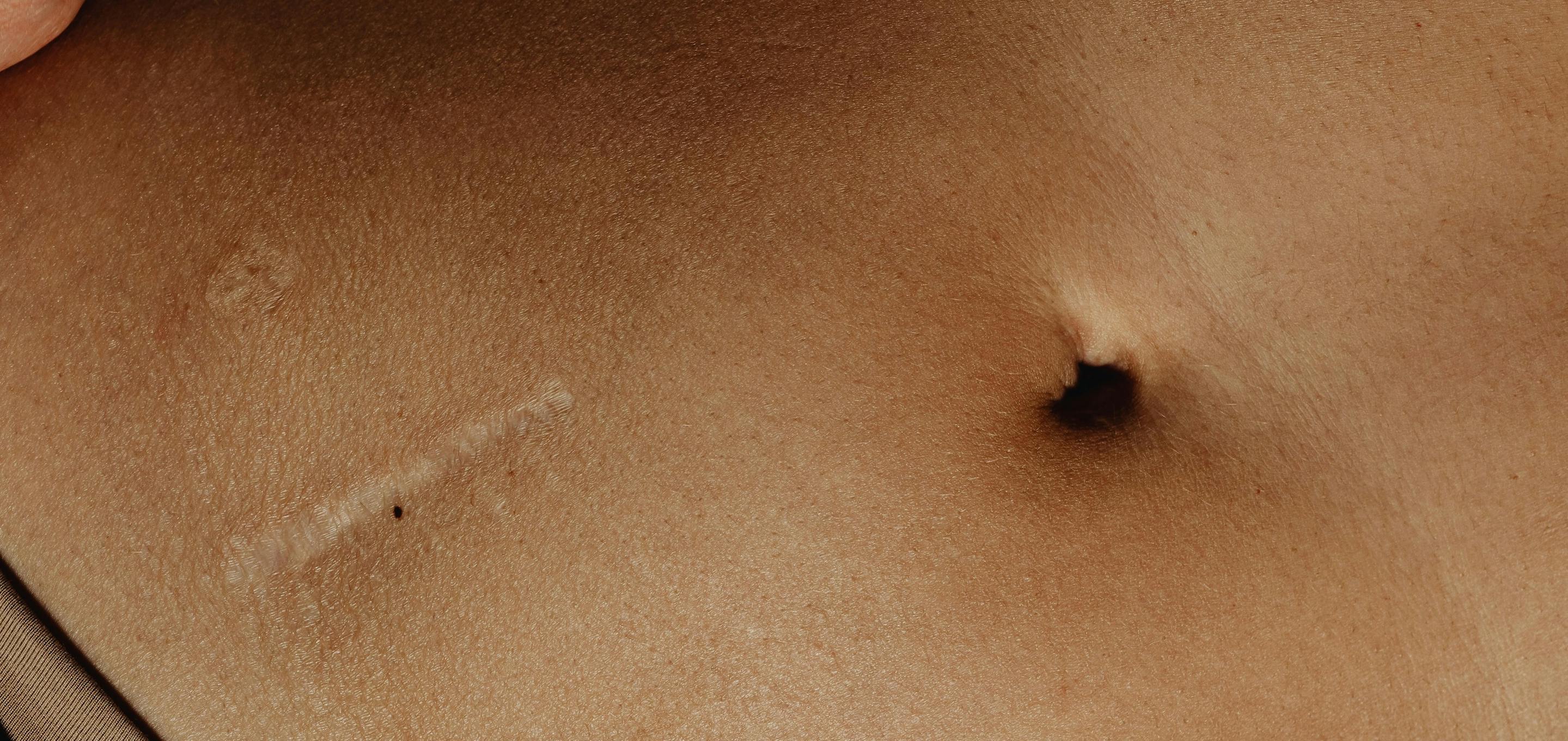 Scar on stomach
