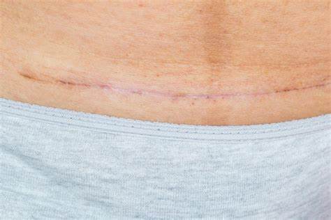 a c-section scar