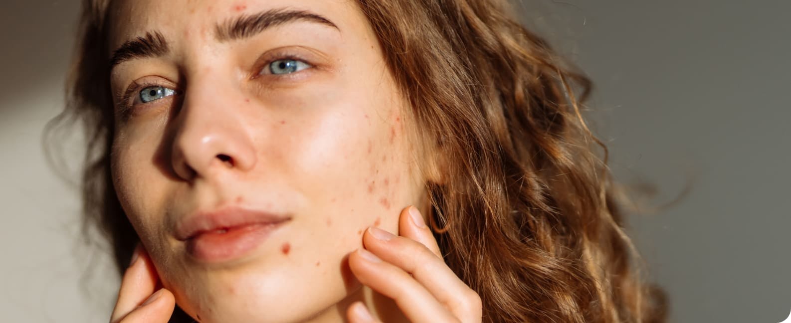 Skin Balance acné hormonale - Onatera