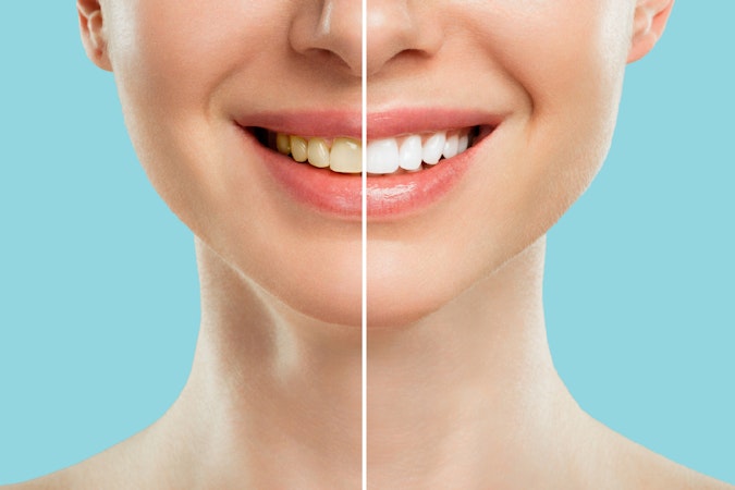 Photos avant/après d'une femme ayant effectué un blanchiment dentaire