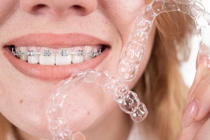 L'importance de la contention en orthodontie