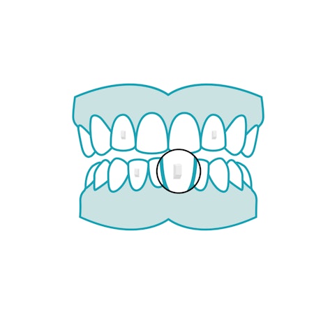 Attachement taquet traitement orthodontique orthlane