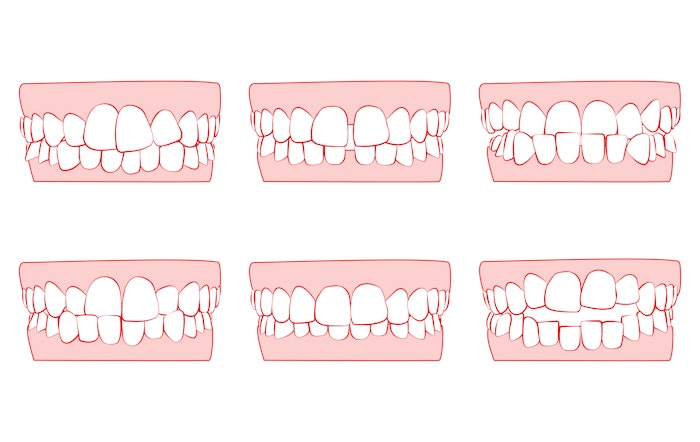 Différents types de malocclusion dentaire