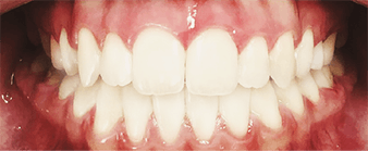 Dents après un traitement orthodontique