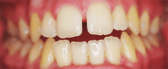 Dents présentant une béance dentaire
