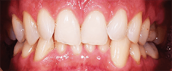 Dents présentant un chevauchement dentaire
