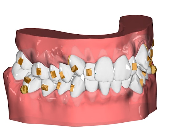 plan de traitement 3D alignement dentaire orthlane