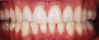 Dents après un traitement orthodontique