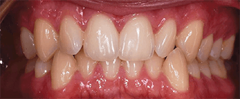 Dents présentant un inversé d'articulé