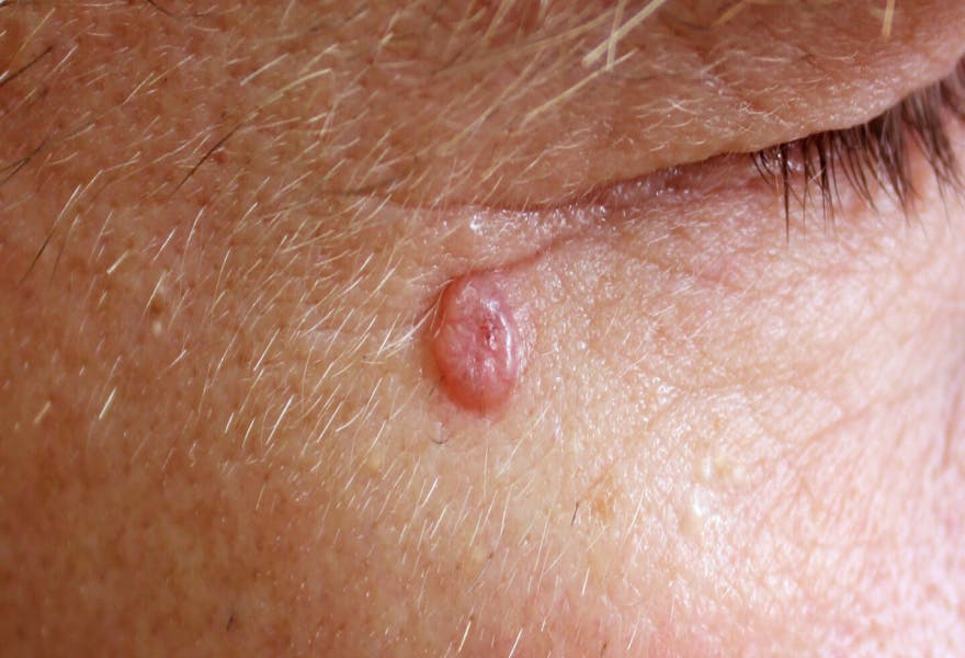 Second type of Basal cell carcinoma