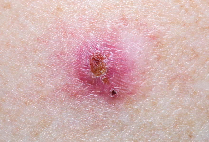 First type of Basal cell carcinoma