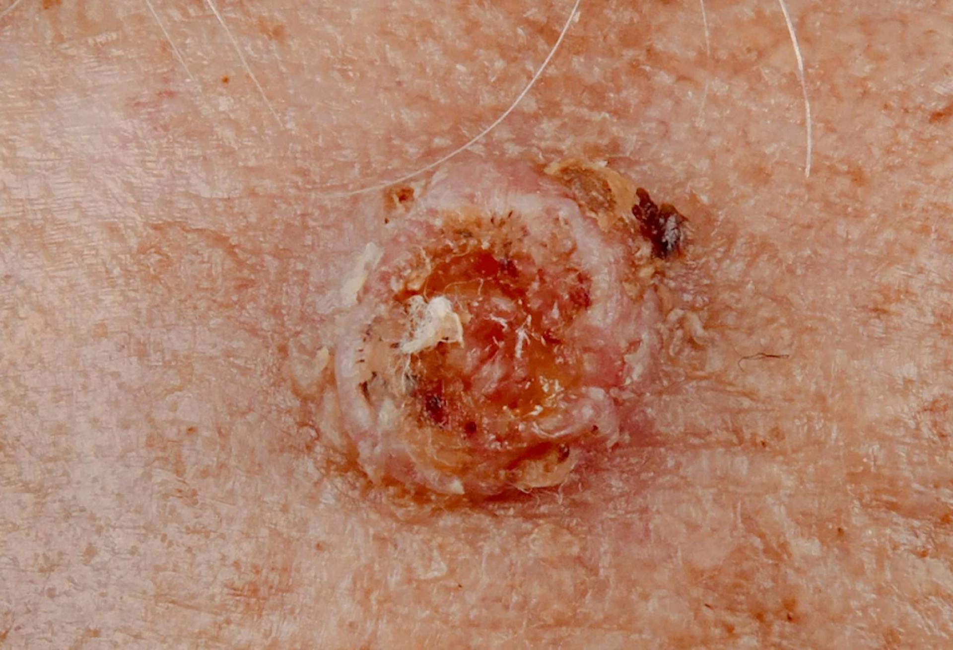 Second type of Squamous cell carcinoma