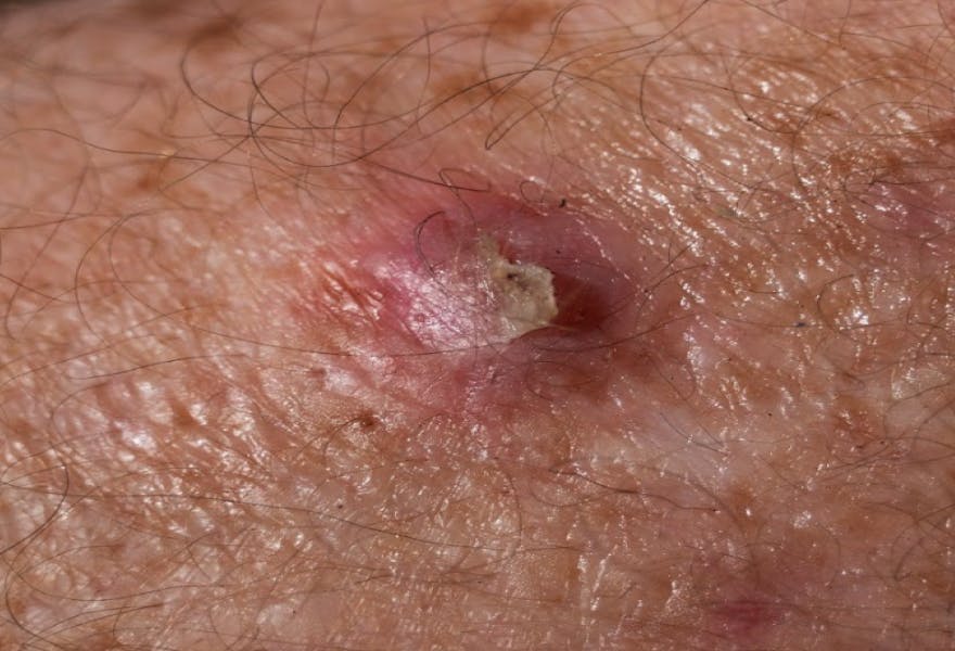 First type of Squamous cell carcinoma