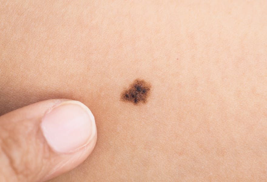 First type of Melanoma