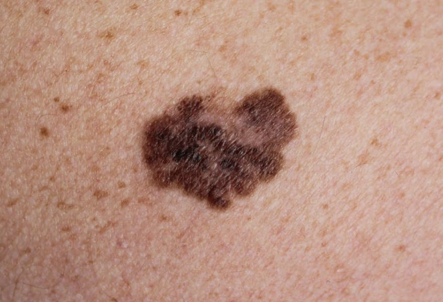 Second type of Melanoma