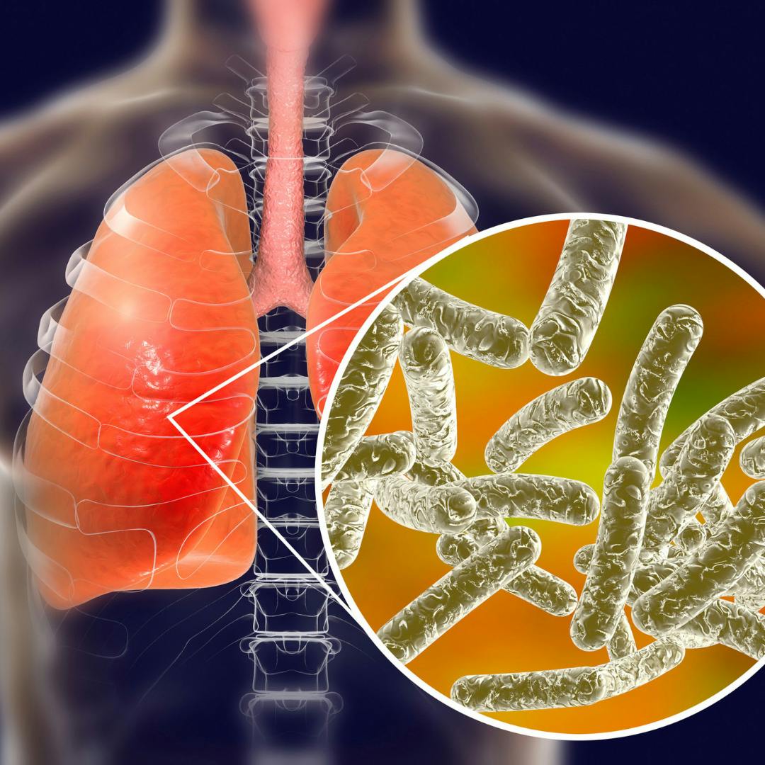 A graphic of a red lung that's got a bacterium pointing to it