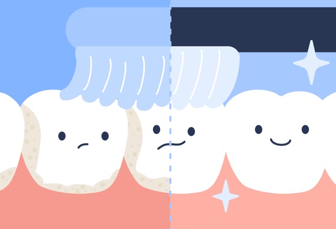 A comparison, showing the teeth surfaces that toothbrushes can't reach