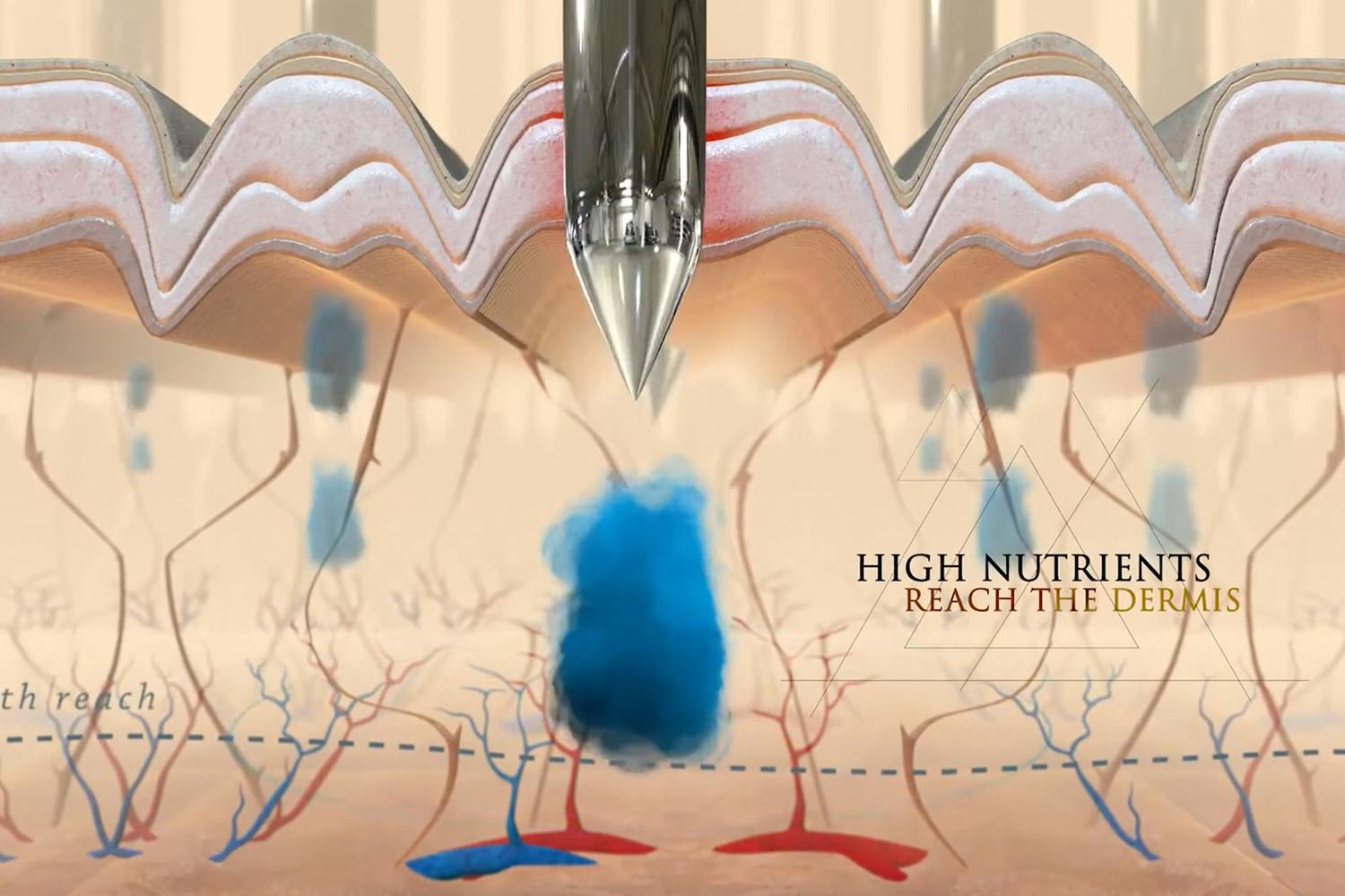 This image shows the microneedles penetrating into the second layer of the skin (dermis) – structure and sections of the skin