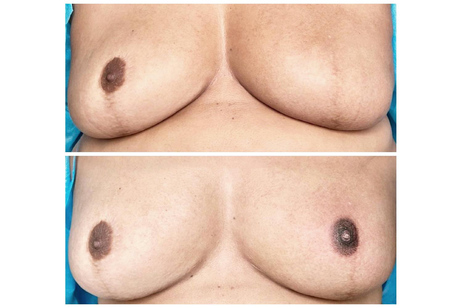 The focus of the PhiAreola treatment is to adapt to the new shape, size, texture, color and position on the chest. PhiAreola also removes scars from previous breast surgeries.