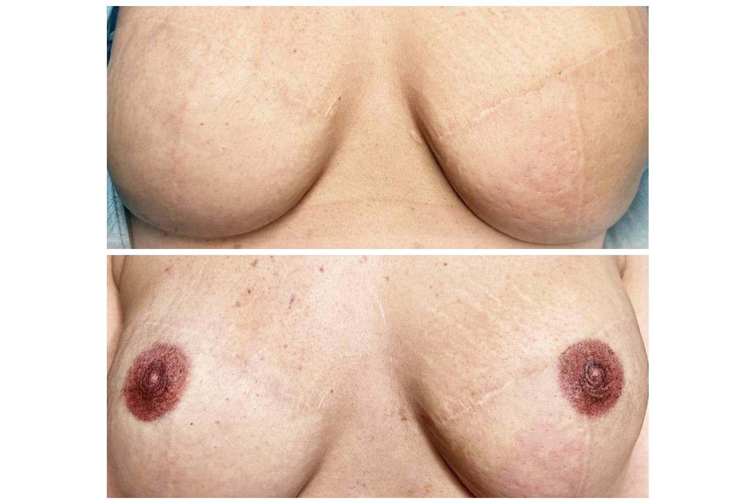 The process of areola repigmentation is akin to a skilled restorer who steps in, with steady hands and a keen eye, understanding the value and significance of this masterpiece.