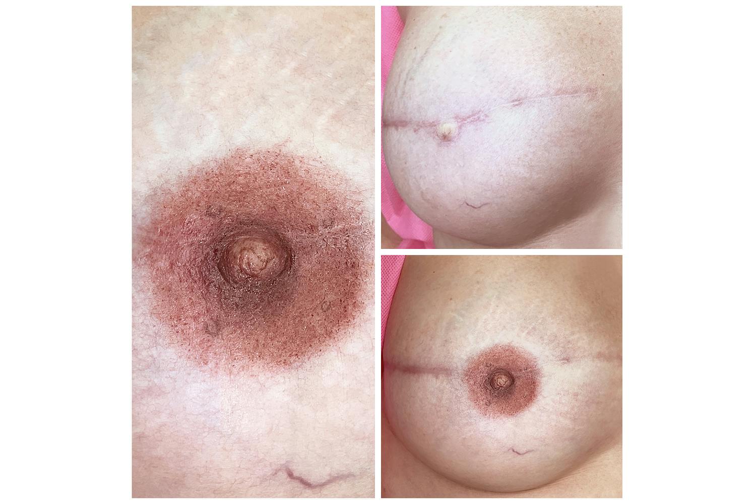 Areola reconstruction (or repigmentation), for women who have fought and conquered breast cancer, is like seeing the first shoots of green after a devastating forest fire.