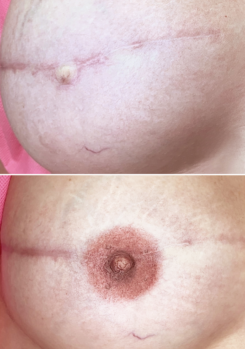 Areola Reconstruction technique by PhiAcademy