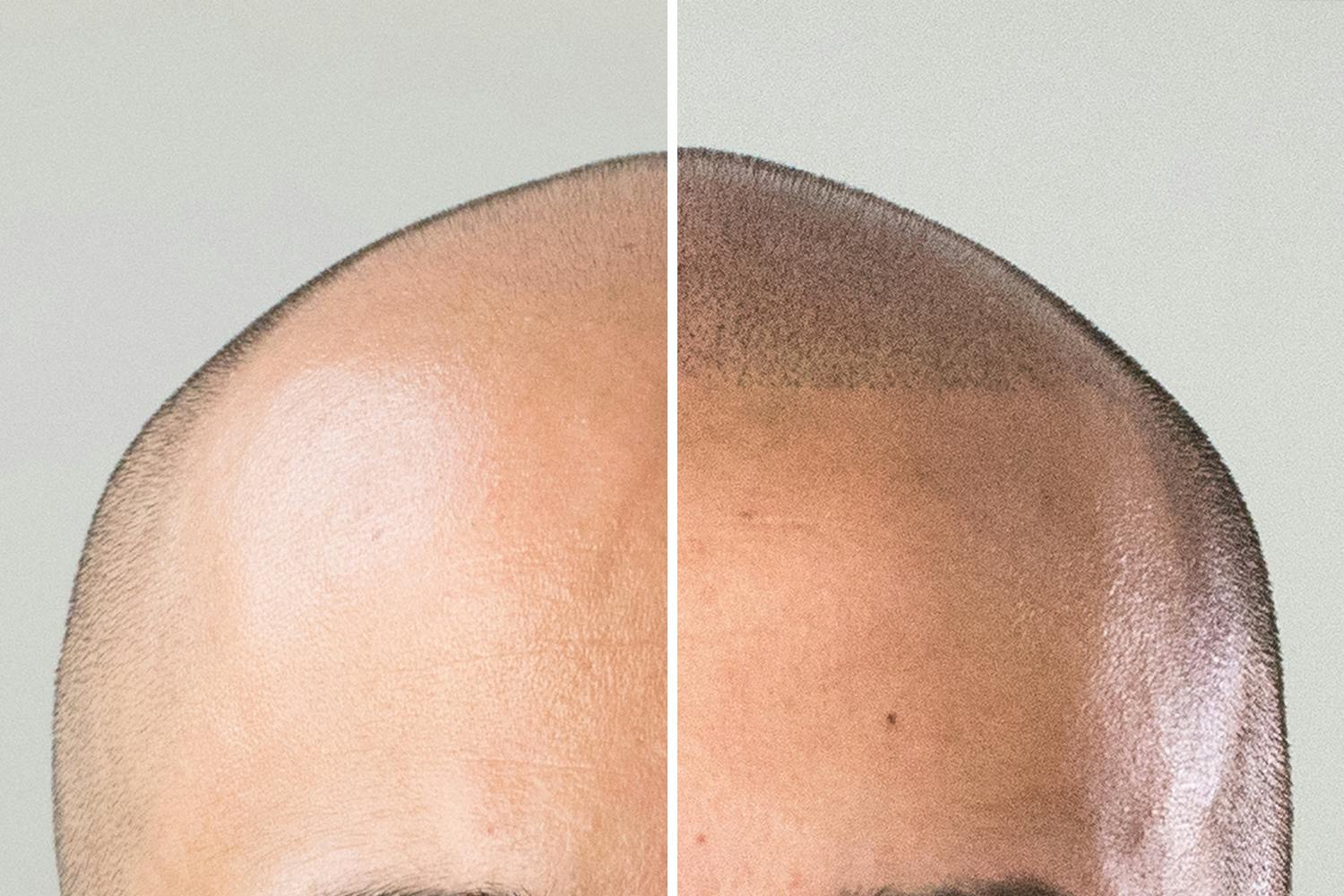 With a micropigmentation technique that stimulates hair follicles, can solve Alopecia completely pain-free