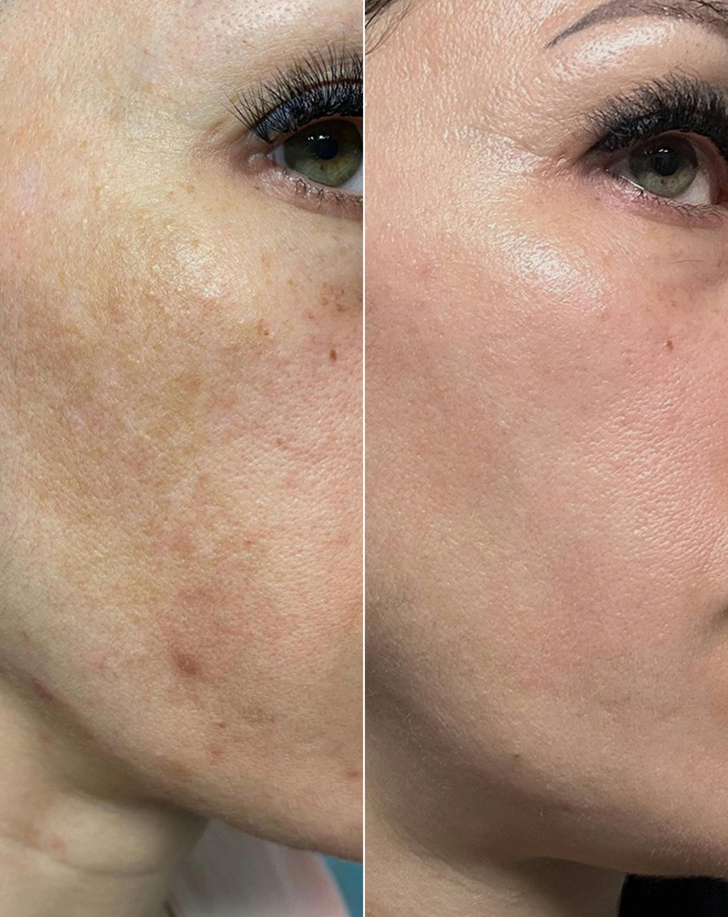 La tecnica ibrida al plasma Phiusion è utilizzata per iperpigmentazione, melasma e macchie scure
