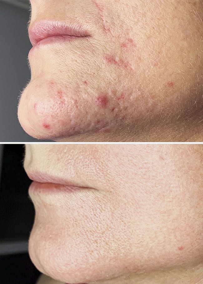 La tecnica ibrida al plasma Phiusion è utilizzata per acne e cicatrici da acne