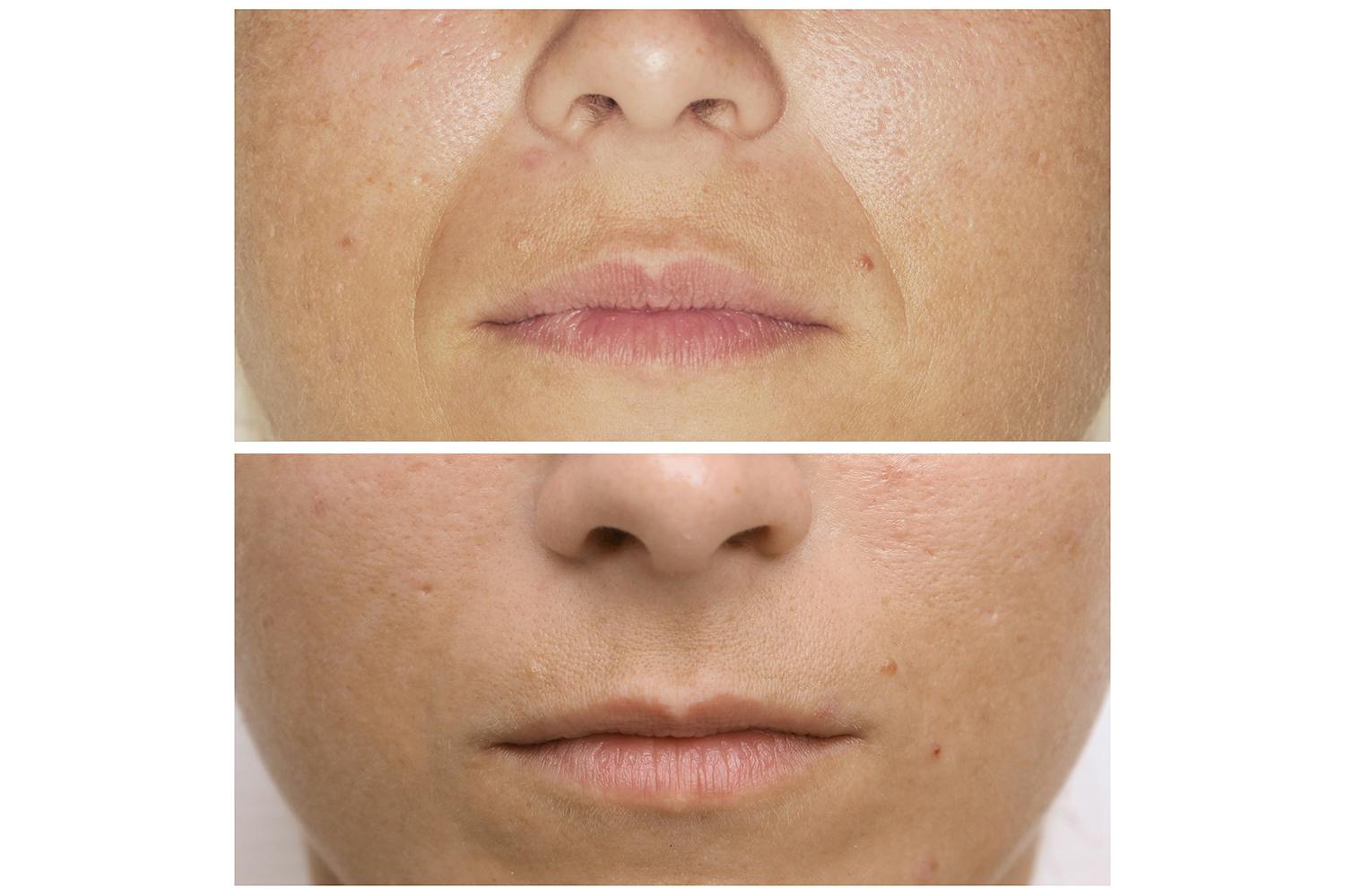 In photo: Microneedling PhiBright - before and after