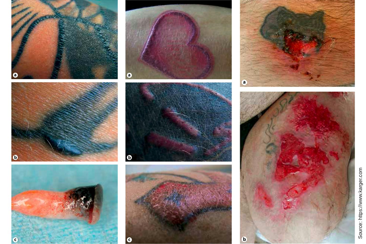 The researchers, led by Dr. Ines Schreiver, analyzed 58 commercially available tattoo inks, shedding light on the dark side of the tattoo industry.