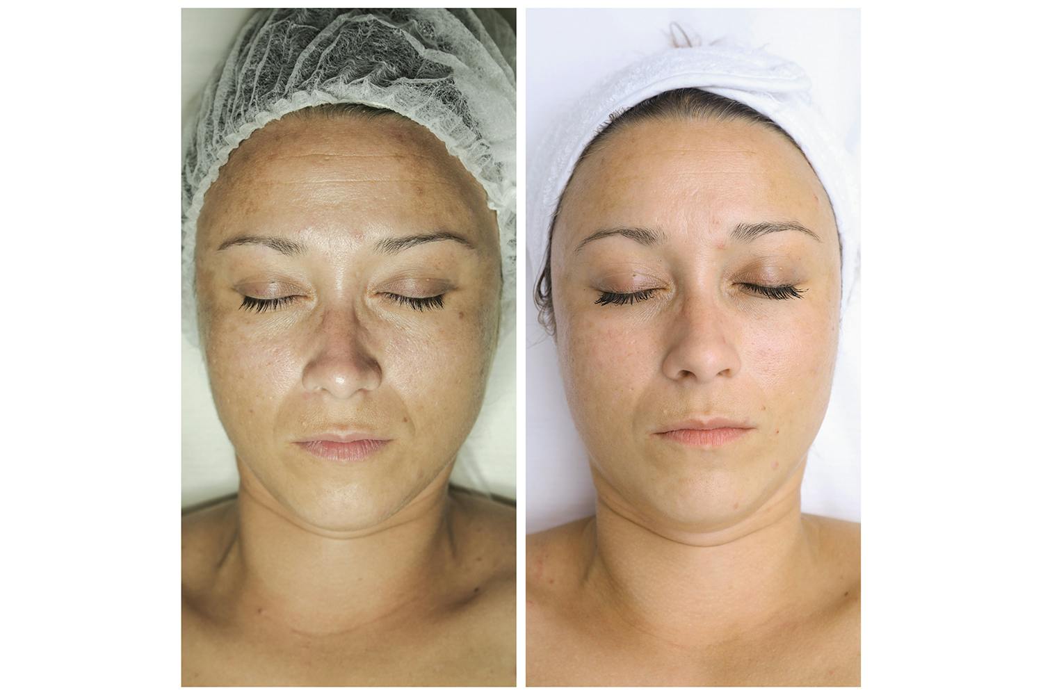 In photo: Microneedling before and after – PhiAcademy