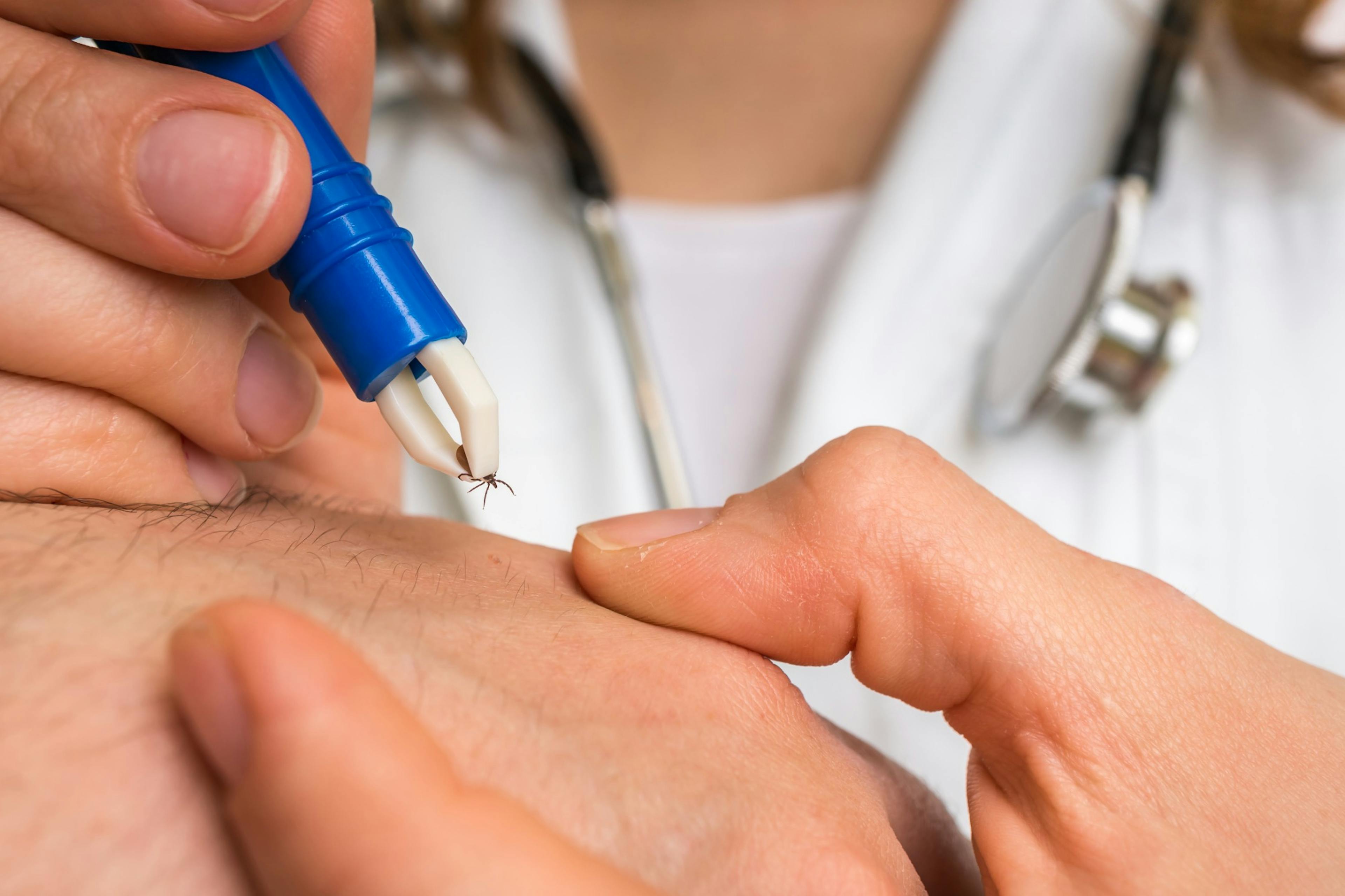 doctor removing a tick