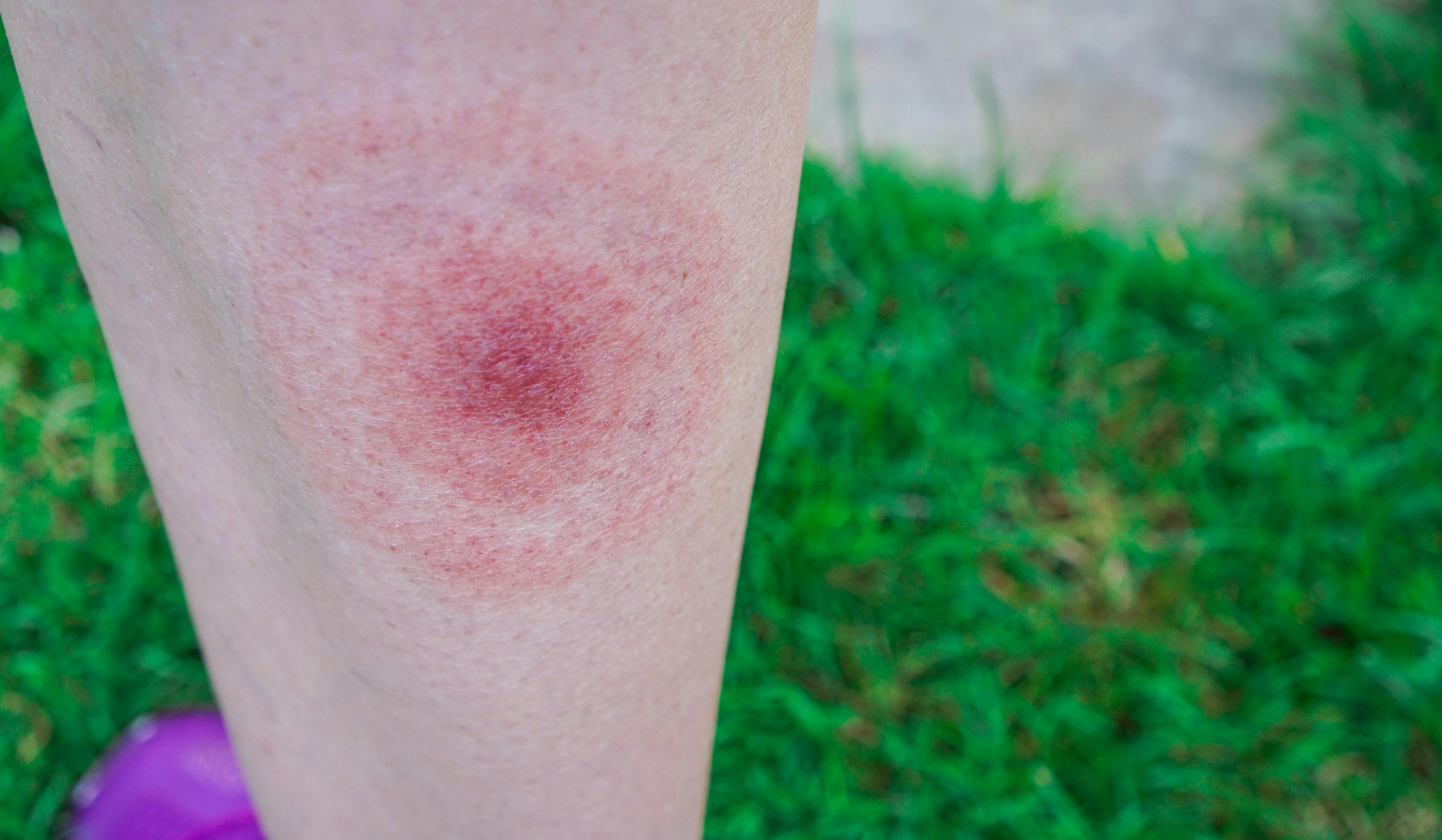 Lyme disease rash