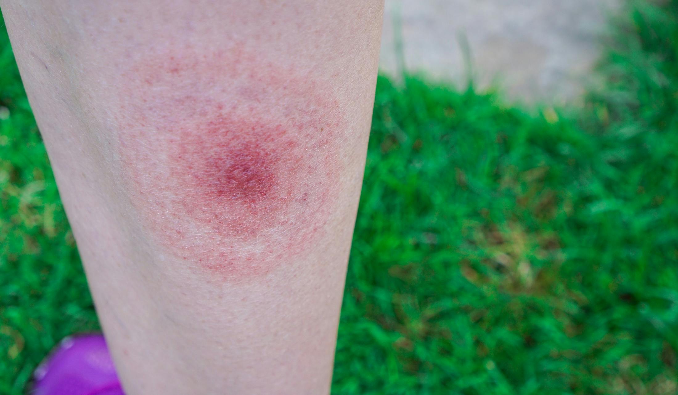 Lyme disease rash