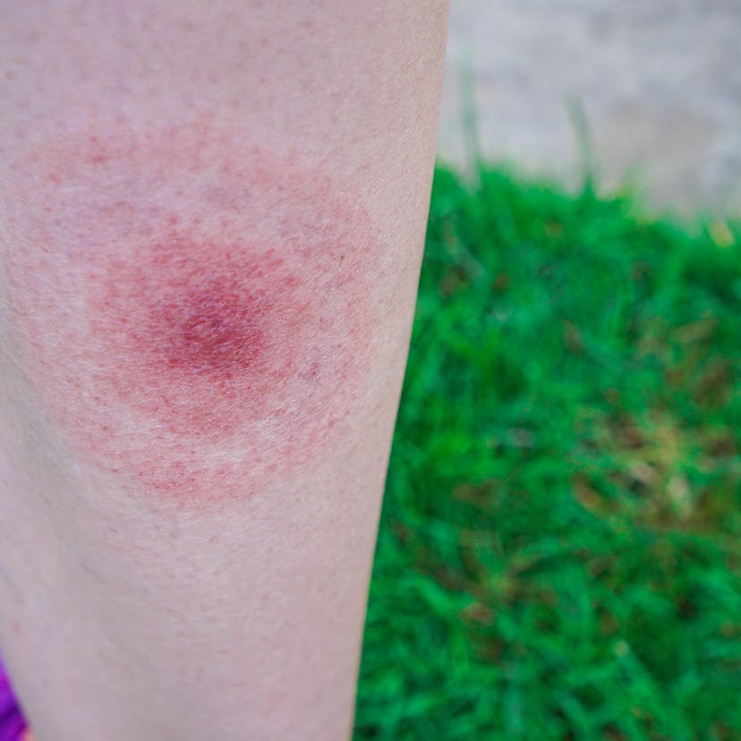 Lyme disease rash