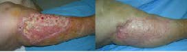 Reparación de úlceras en las piernas y los pies. Recuperar la piel en miembros inferiores