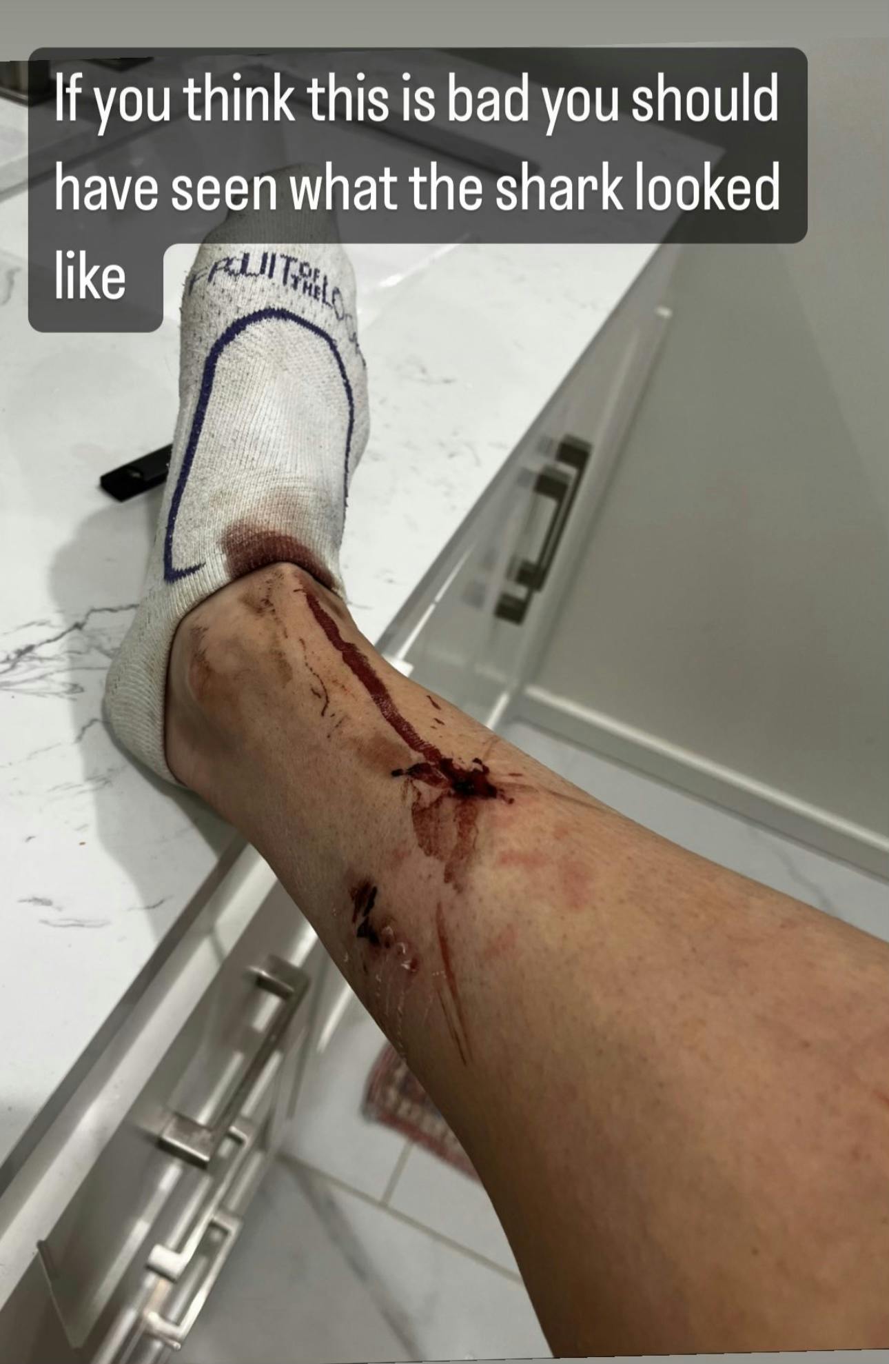 Photo of a dog bite on Athena Anderson's her lower leg