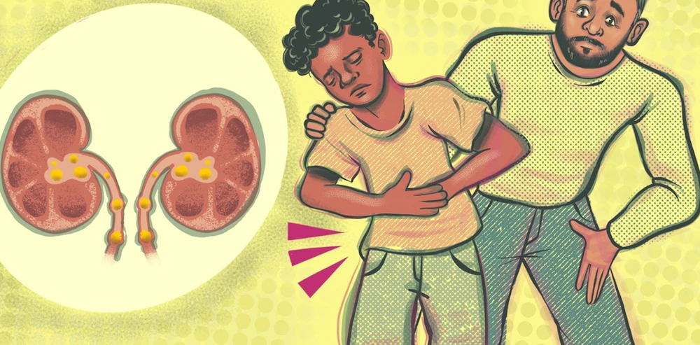 An Alarming Surge in Kidney Stones Among Children